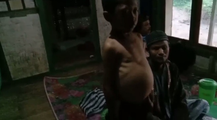 Warga Sinarbakti Kabupaten Cianjur Alami Gizi Buruk